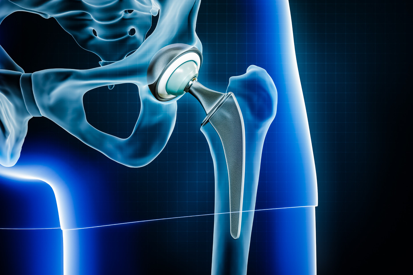 Total Hip Replacement Image