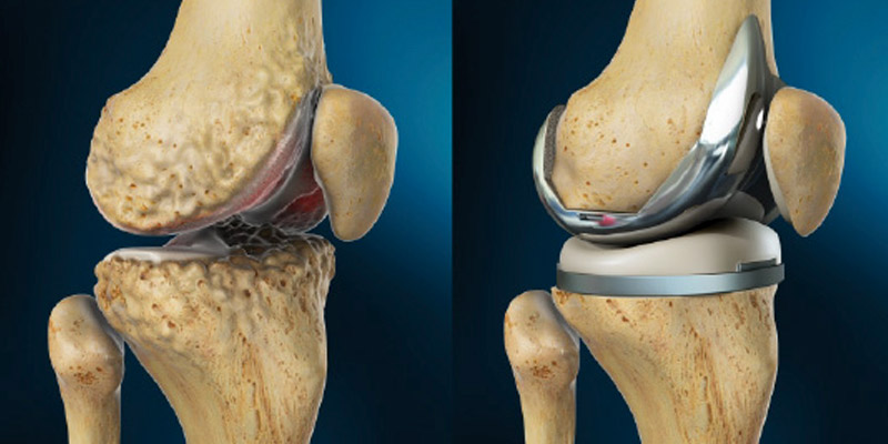 Total Knee Replacement Image
